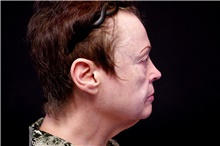 Facelift Before Photo by Landon Pryor, MD, FACS; Rockford, IL - Case 45077