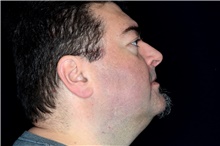 Chemical Peels, IPL, Fractional CO2 Laser Treatments After Photo by Landon Pryor, MD, FACS; Rockford, IL - Case 45080