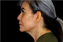 Facelift Before Photo by Landon Pryor, MD, FACS; Rockford, IL - Case 45082