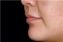 Lip Augmentation/Enhancement After Photo by Landon Pryor, MD, FACS; Rockford, IL - Case 45085