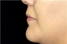Lip Augmentation/Enhancement After Photo by Landon Pryor, MD, FACS; Rockford, IL - Case 45085
