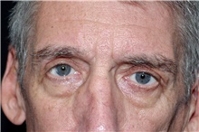 Brow Lift After Photo by Landon Pryor, MD, FACS; Rockford, IL - Case 45086