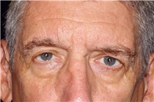 Brow Lift Before Photo by Landon Pryor, MD, FACS; Rockford, IL - Case 45086