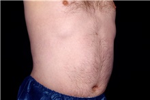 Liposuction After Photo by Landon Pryor, MD, FACS; Rockford, IL - Case 45087