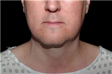 Liposuction After Photo by Landon Pryor, MD, FACS; Rockford, IL - Case 45088