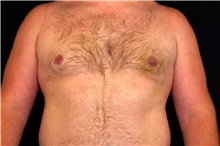 Male Breast Reduction After Photo by Landon Pryor, MD, FACS; Rockford, IL - Case 45089