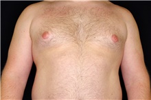 Male Breast Reduction Before Photo by Landon Pryor, MD, FACS; Rockford, IL - Case 45089