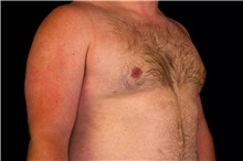Male Breast Reduction After Photo by Landon Pryor, MD, FACS; Rockford, IL - Case 45089