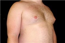 Male Breast Reduction Before Photo by Landon Pryor, MD, FACS; Rockford, IL - Case 45089