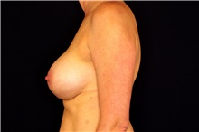 Breast Augmentation After Photo by Landon Pryor, MD, FACS; Rockford, IL - Case 45090