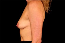 Breast Augmentation Before Photo by Landon Pryor, MD, FACS; Rockford, IL - Case 45090