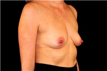 Breast Augmentation Before Photo by Landon Pryor, MD, FACS; Rockford, IL - Case 45090