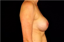 Breast Augmentation After Photo by Landon Pryor, MD, FACS; Rockford, IL - Case 45090