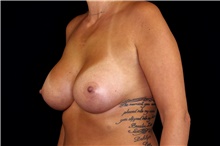 Breast Augmentation After Photo by Landon Pryor, MD, FACS; Rockford, IL - Case 45091