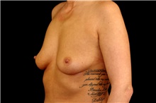 Breast Augmentation Before Photo by Landon Pryor, MD, FACS; Rockford, IL - Case 45091