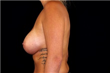 Breast Augmentation After Photo by Landon Pryor, MD, FACS; Rockford, IL - Case 45091