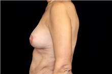 Breast Lift After Photo by Landon Pryor, MD, FACS; Rockford, IL - Case 45092