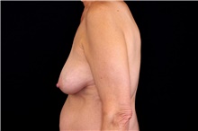 Breast Lift Before Photo by Landon Pryor, MD, FACS; Rockford, IL - Case 45092