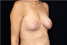 Breast Lift After Photo by Landon Pryor, MD, FACS; Rockford, IL - Case 45092