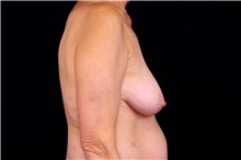Breast Lift Before Photo by Landon Pryor, MD, FACS; Rockford, IL - Case 45092
