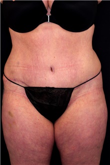 Tummy Tuck After Photo by Landon Pryor, MD, FACS; Rockford, IL - Case 45093