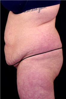 Tummy Tuck Before Photo by Landon Pryor, MD, FACS; Rockford, IL - Case 45093