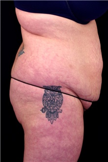 Tummy Tuck Before Photo by Landon Pryor, MD, FACS; Rockford, IL - Case 45093