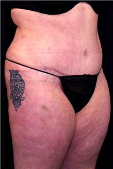 Tummy Tuck After Photo by Landon Pryor, MD, FACS; Rockford, IL - Case 45093