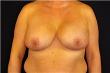 Breast Implant Revision After Photo by Landon Pryor, MD, FACS; Rockford, IL - Case 45094