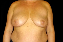 Breast Implant Revision Before Photo by Landon Pryor, MD, FACS; Rockford, IL - Case 45094