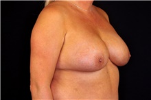 Breast Implant Revision After Photo by Landon Pryor, MD, FACS; Rockford, IL - Case 45094