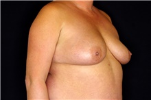 Breast Implant Revision Before Photo by Landon Pryor, MD, FACS; Rockford, IL - Case 45094