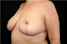 Breast Reduction After Photo by Landon Pryor, MD, FACS; Rockford, IL - Case 45095