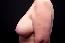 Breast Reduction Before Photo by Landon Pryor, MD, FACS; Rockford, IL - Case 45095