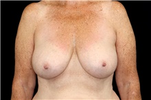 Breast Augmentation After Photo by Landon Pryor, MD, FACS; Rockford, IL - Case 45097
