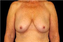 Breast Augmentation Before Photo by Landon Pryor, MD, FACS; Rockford, IL - Case 45097