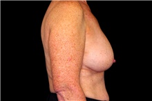 Breast Augmentation Before Photo by Landon Pryor, MD, FACS; Rockford, IL - Case 45097