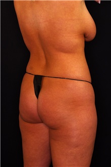 Buttock Lift with Augmentation Before Photo by Landon Pryor, MD, FACS; Rockford, IL - Case 45098