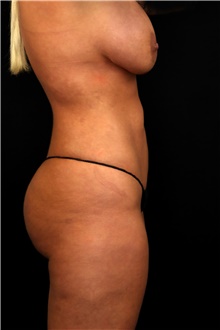 Buttock Lift with Augmentation After Photo by Landon Pryor, MD, FACS; Rockford, IL - Case 45098