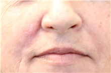 Head and Neck Skin Cancer Reconstruction After Photo by Landon Pryor, MD, FACS; Rockford, IL - Case 45099