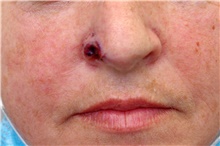 Head and Neck Skin Cancer Reconstruction Before Photo by Landon Pryor, MD, FACS; Rockford, IL - Case 45099