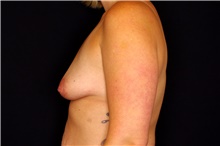 Breast Augmentation Before Photo by Landon Pryor, MD, FACS; Rockford, IL - Case 45100