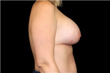 Breast Augmentation After Photo by Landon Pryor, MD, FACS; Rockford, IL - Case 45100
