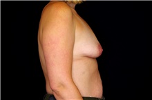 Breast Augmentation Before Photo by Landon Pryor, MD, FACS; Rockford, IL - Case 45100
