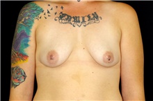 Breast Augmentation Before Photo by Landon Pryor, MD, FACS; Rockford, IL - Case 45101