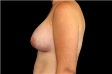 Breast Augmentation After Photo by Landon Pryor, MD, FACS; Rockford, IL - Case 45101