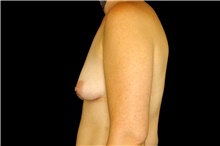 Breast Augmentation Before Photo by Landon Pryor, MD, FACS; Rockford, IL - Case 45101