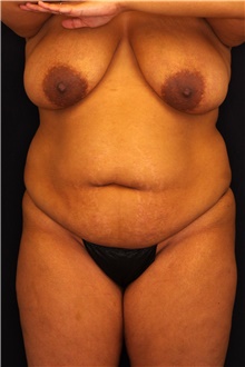 Buttock Lift with Augmentation Before Photo by Landon Pryor, MD, FACS; Rockford, IL - Case 45102