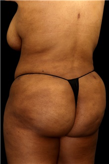 Buttock Lift with Augmentation After Photo by Landon Pryor, MD, FACS; Rockford, IL - Case 45102