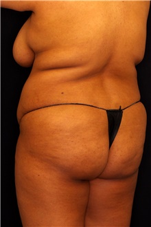 Buttock Lift with Augmentation Before Photo by Landon Pryor, MD, FACS; Rockford, IL - Case 45102